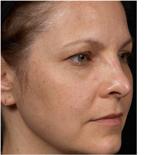 Her face after six treatments with Clear + Brilliant laser.