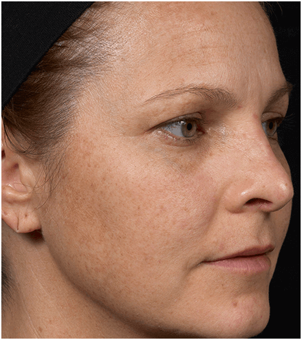 Womans face before treatment with Clear + Brilliant laser.