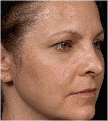 Her face after six treatments with Clear + Brilliant laser.