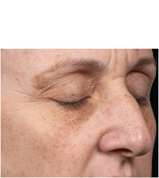 Her face after six treatments with Clear + Brilliant laser.