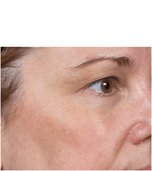 Her face after six treatments with Clear + Brilliant laser.