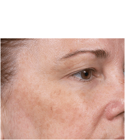 Womans face before treatment with Clear + Brilliant laser.