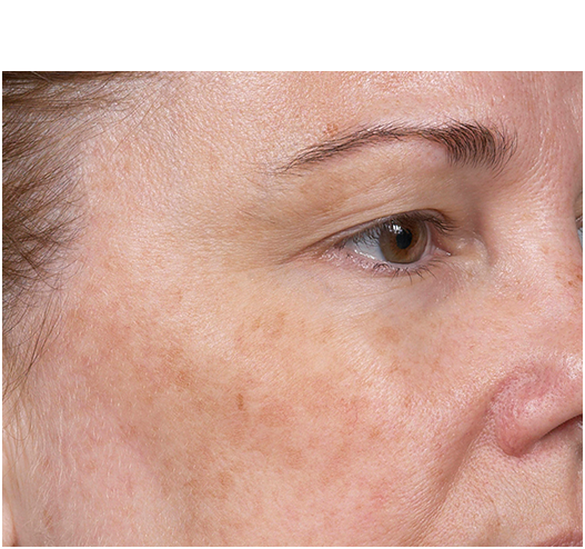 Womans face before treatment with Clear + Brilliant laser.